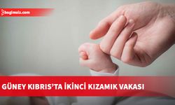 Güney Kıbrıs’ta ikinci kızamık vakası