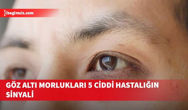 Göz altı morluklarının gizli riski: 5 ciddi hastalığın sinyali