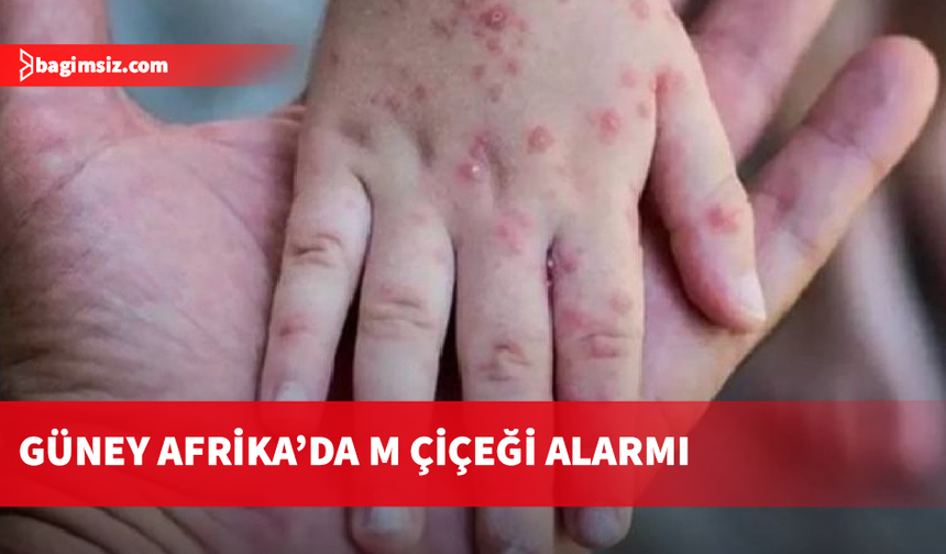 Güney Afrika’da son 5 haftada 13 M çiçeği vakası kaydedildi